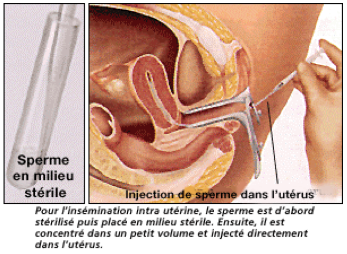 insémination intra utérine grossesse insémination intra utérine grossesse
